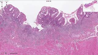 Ulcerative Colitis  Histopathology [upl. by Ernaline691]