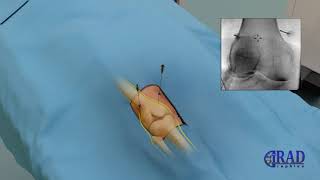 Genicular Artery Embolization LIVE PROCEDURE [upl. by Meehaf]