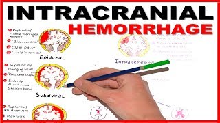 Intracranial Hemorrhage EpiduralSubduralSubarachnoid overview [upl. by Howund]