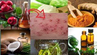 15 Natural Remedies How To Treat Folliculitis At Home [upl. by Alley]