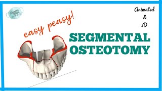 SEGMENTAL OSTEOTOMY  MAXILLARY OSTEOTOMY [upl. by Gschu]