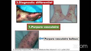 🔴Hématologie Pathologies de lhémostase [upl. by Ylrahc]