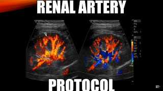 Renal Artery Doppler Protocol  Sonoquickies [upl. by Alram]