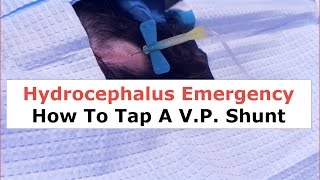 Hydrocephalus Emergency How to Tap a VP Shunt [upl. by Atte905]