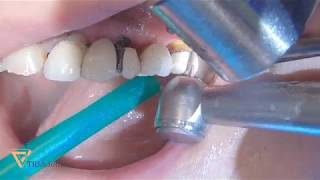 Bridge sectioning and premolar extraction [upl. by Aisitel]