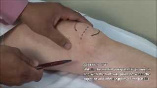 Knee Injection  Medial Approach [upl. by Noirred]