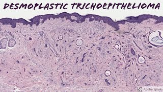 Desmoplastic Trichoepithelioma 5Minute Pathology Pearls [upl. by Sezen602]