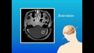 Opportunistic Fungi  Aspergillus Mucormycosis P jirovecii Candida amp Cryptococcus STEP1 [upl. by Forsta808]