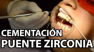 Cementación Puente Zirconia 6 Unidades👅Parte2 [upl. by Annawat420]