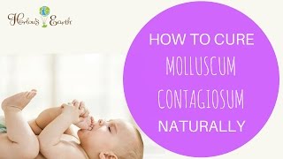 How To Cure Molluscum Contagiosum Naturally [upl. by Ydna]