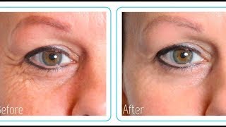 Hyaluronic Acid Before And After MY RESULTS [upl. by Elletnuahs]