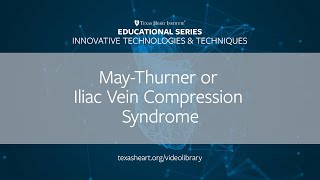 Episode 6  MayThurner or Iliac Vein Compression Syndrome [upl. by Wolbrom]