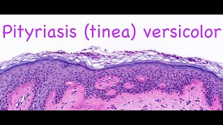 Pityriasis tinea versicolor [upl. by Pembrook]