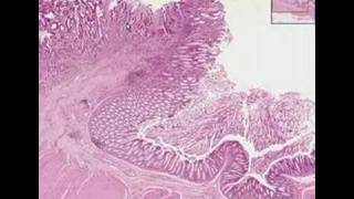 Histopathology ColonAdenocarcinoma [upl. by Grae]