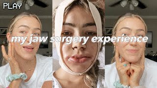 UNDERBITE JAW SURGERY  vlog  recovery days 114  before amp after [upl. by Orihakat]