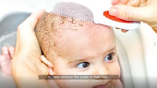 What You Need to Know About Cradle Cap [upl. by Hsekar65]