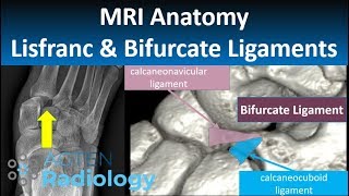 Lisfranc and Bifurcate Ligaments MRI Anatomy [upl. by Philana]