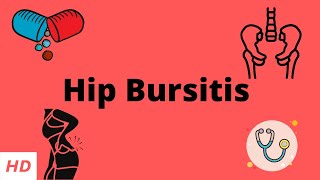 Hip Bursitis Causes Signs and Symptoms Diagnosis and Treatment [upl. by Eimar]