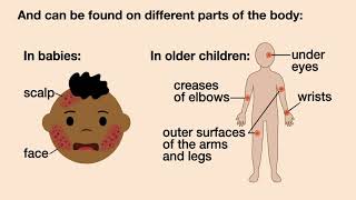 Does My Child have Eczema  American Academy of Pediatrics AAP [upl. by Cadel]