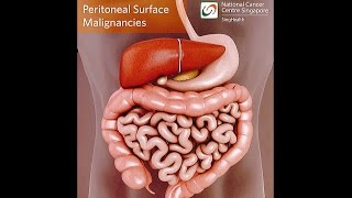 All About Peritoneal Tumours Causes Symptoms Diagnosis and Treatment [upl. by Ayra829]