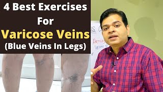 Varicose Veins Exercise Blue Veins in Legs Spider Veins Exercise Varicose Veins Treatment At Home [upl. by Airenahs950]