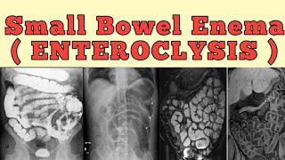 Small bowel enema  Enteroclysis [upl. by Jacobs]