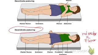 Decerebrate Vs Decorticate Posturing [upl. by Lyrret939]