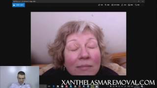 Xanthelasma Removal With TCA [upl. by Anekam878]