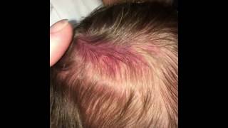 SUBGALEAL HEMATOMA NEWBORN BABY [upl. by Ymassej]