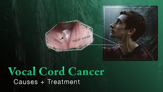 Early Vocal Cord Cancer  Introduction and Treatment Options [upl. by Launce]