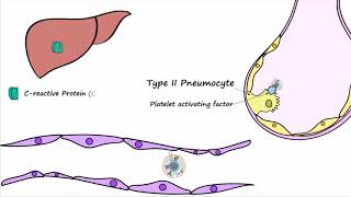 Bacterial Pneumonia  Pathogenesis [upl. by Ailerua805]