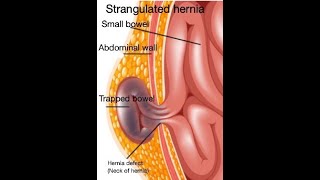 Strangulated hernia symptoms [upl. by Dirraj]