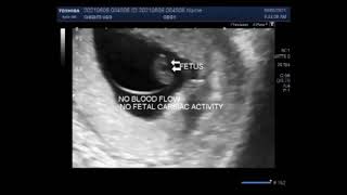 Early twin pregnancy with one blighted ovum and other missed abortion [upl. by Shir]