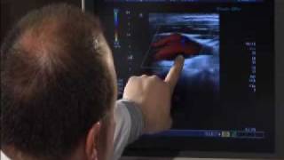 Carotid Artery Ultrasound [upl. by Alracal]