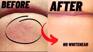 How To Remove Whiteheads And Blackheads From Chin At Home [upl. by Menzies]