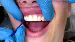 Tips For Applying Fluoride Varnish [upl. by Durham]