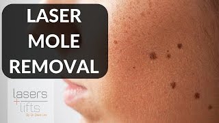 LASER MOLE REMOVAL [upl. by Hteboj430]