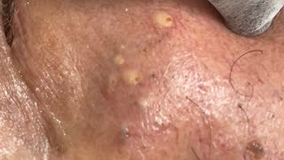 SUPER SATISFYING Blackheads Removal [upl. by Antipas]