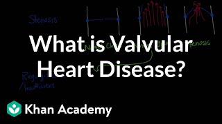 What is Coronary Artery Disease  Mechanism of Disease [upl. by Yrocaj]