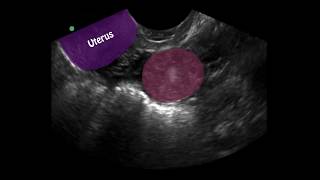 POCUS 1st Trimester Pregnancy Case 4  Ectopic Pregnancy [upl. by Jourdan]