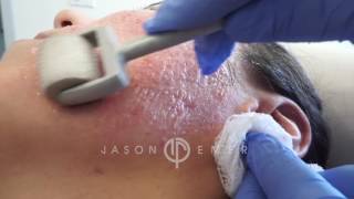 Dermaroller  Microneedling Acne Scars  Skin Resurfacing  Los Angeles California [upl. by Atiekram]