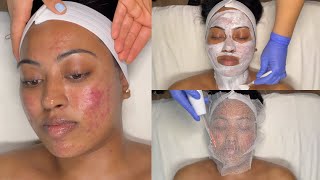 CYSTIC ACNE TREATMENT  WALKIN FACIAL FOR GRADE 3 AND 4 ACNE WITH PRO TIPS  LICENSED ESTHETICIAN [upl. by Adelbert]