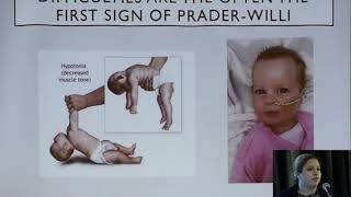 Prader Willi Syndrome Journey [upl. by Candis]