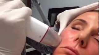 Infini demonstration by Dr Steven Weiner RF Microneedling Skin Tightening [upl. by Ibob]