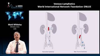 Pelvic congestion syndrome explained by Prof Mark Whiteley [upl. by Anabel]