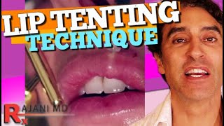 LIP FILLER RUSSIAN TENTING TECHNIQUE Demonstrated  Lip Filler Before and After [upl. by Heti]