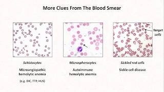 Anemia Lesson 4  Clues from the blood smear [upl. by Marjorie827]