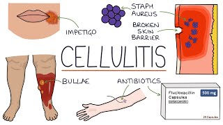 What is Cellulitis  Symptoms and Treatment Options [upl. by Devi]