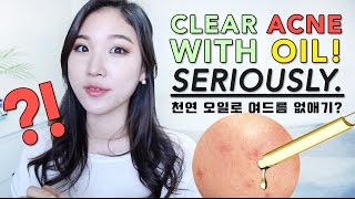 CLEAR ACNE WITH OIL • BEST Oils for Acne Prone Skin [upl. by Aerdnaz]