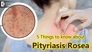 5 Things to know about Pityriasis Rosea  Pityriasis Rosea Rash  Dr Divya SharmaDoctors Circle [upl. by Vaientina]